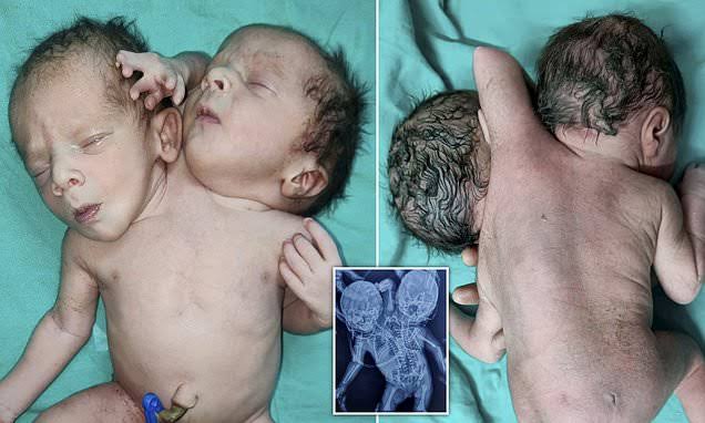 Baby Born With Two Heads Survives Birth